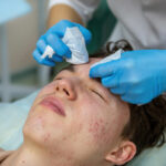 Stop Acne & Breakouts - Best Facial Treatment for Acne JB - Jupiter Skin Care